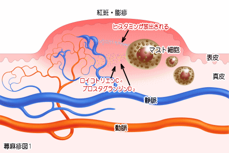 じんましん発症システム1