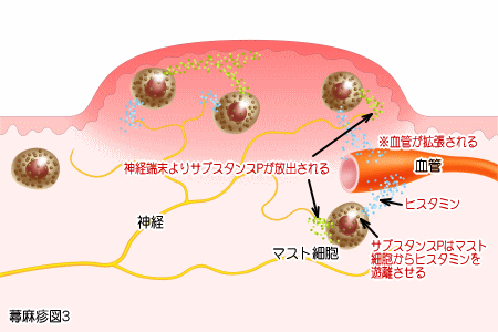 じんましん発症システム3