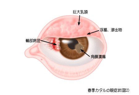 春季カタル