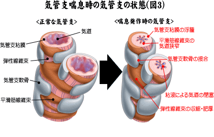 気管支喘息